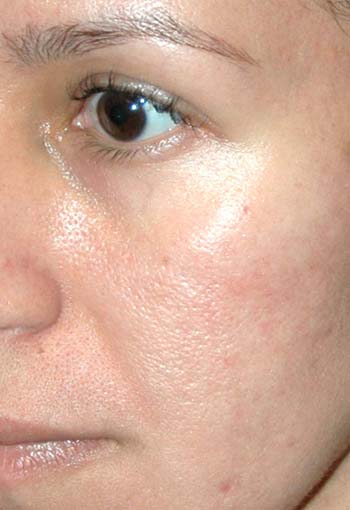 FAT TRANSFER - Patient - Before